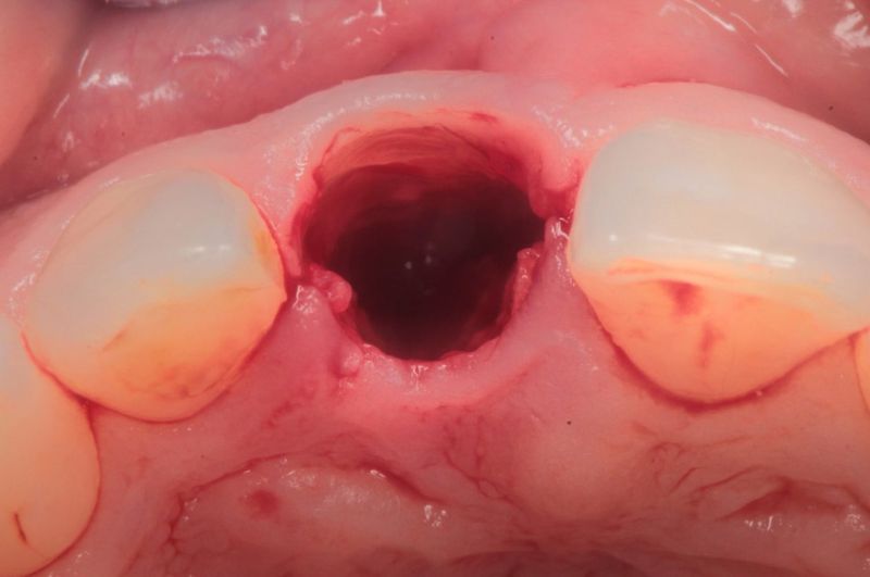 wszczepienie implantu zaraz po usunięciu zęba